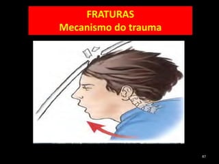 87
FRATURAS
Mecanismo do trauma
 