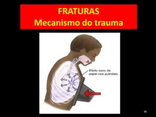 88
FRATURAS
Mecanismo do trauma
 