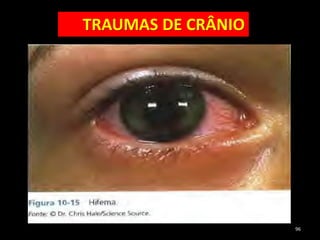 96
TRAUMAS DE CRÂNIO
 