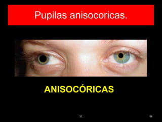 Pupilas anisocoricas.
51 98
ANISOCÓRICAS
 