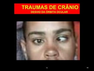 51 99
TRAUMAS DE CRÂNIO
DESVIO DA ÓRBITA OCULAR
 