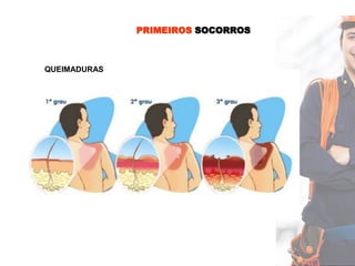 PRIMEIROS SOCORROS
QUEIMADURAS
 