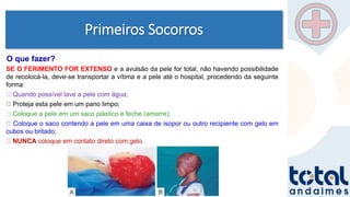 Primeiros Socorros
SE O FERIMENTO FOR EXTENSO e a avulsão da pele for total, não havendo possibilidade
de recolocá-la, deve-se transportar a vítima e a pele até o hospital, procedendo da seguinte
forma:
Quando possível lave a pele com água;
Proteja esta pele em um pano limpo;
Coloque a pele em um saco plástico e feche (amarre);
Coloque o saco contendo a pele em uma caixa de isopor ou outro recipiente com gelo em
cubos ou britado;
NUNCA coloque em contato direto com gelo.
O que fazer?
 