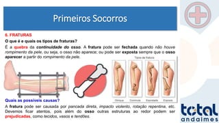 Primeiros Socorros
6. FRATURAS
O que é e quais os tipos de fraturas?
É a quebra da continuidade do osso. A fratura pode ser fechada quando não houve
rompimento da pele, ou seja, o osso não aparece; ou pode ser exposta sempre que o osso
aparecer a partir do rompimento da pele.
Quais as possíveis causas?
A fratura pode ser causada por pancada direta, impacto violento, rotação repentina, etc.
Devemos ficar atentos, pois além do osso outras estruturas ao redor podem ser
prejudicadas, como tecidos, vasos e tendões.
 