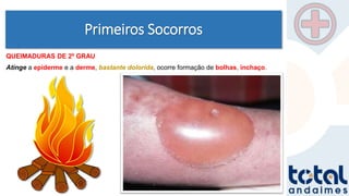 Primeiros Socorros
QUEIMADURAS DE 2º GRAU
Atinge a epiderme e a derme, bastante dolorida, ocorre formação de bolhas, inchaço.
 