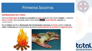 Primeiros Socorros
QUEIMADURAS DE 3º GRAU
Há uma destruição de todas as camadas da pele, atingindo até mesmo órgãos – podendo
levar a morte. Sua coloração pode variar desde branca, avermelhada, escura ou
carbonizada.
Ela é indolor devido à destruição das terminações nervosas no local, porém a área ao
redor é dolorosa por normalmente apresentar queimaduras de primeiro e segundo grau.
 