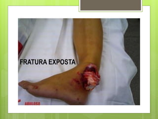 FRATURA EXPOSTA
 