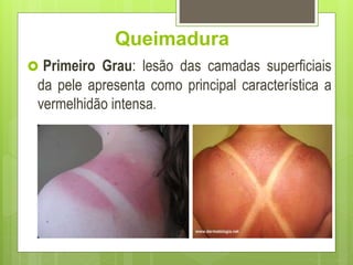 Queimadura
 Primeiro Grau: lesão das camadas superficiais
da pele apresenta como principal característica a
vermelhidão intensa.
 