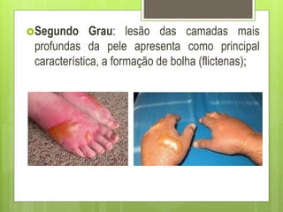 Segundo Grau: lesão das camadas mais
profundas da pele apresenta como principal
característica, a formação de bolha (flictenas);
 
