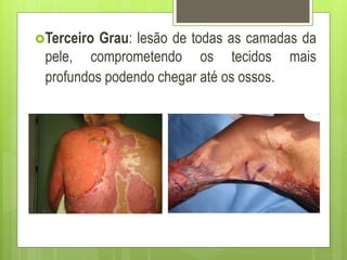 Terceiro Grau: lesão de todas as camadas da
pele, comprometendo os tecidos mais
profundos podendo chegar até os ossos.
 