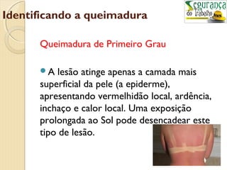Identificando a queimadura 
Queimadura de Primeiro Grau 
A lesão atinge apenas a camada mais 
superficial da pele (a epiderme), 
apresentando vermelhidão local, ardência, 
inchaço e calor local. Uma exposição 
prolongada ao Sol pode desencadear este 
tipo de lesão. 
 