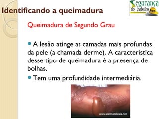 Identificando a queimadura 
Queimadura de Segundo Grau 
A lesão atinge as camadas mais profundas 
da pele (a chamada derme). A característica 
desse tipo de queimadura é a presença de 
bolhas. 
Tem uma profundidade intermediária. 
 