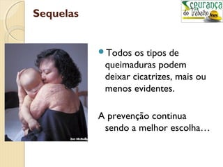 Sequelas 
Todos os tipos de 
queimaduras podem 
deixar cicatrizes, mais ou 
menos evidentes. 
A prevenção continua 
sendo a melhor escolha… 
 