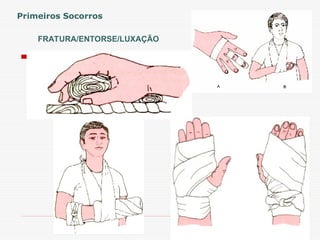 FRATURA/ENTORSE/LUXAÇÃO
Primeiros Socorros
 