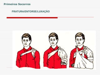 FRATURA/ENTORSE/LUXAÇÃO
Primeiros Socorros
 