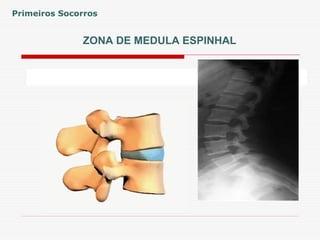 ZONA DE MEDULA ESPINHAL
Primeiros Socorros
 