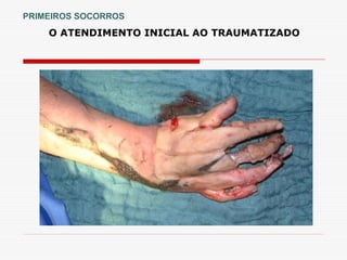 O ATENDIMENTO INICIAL AO TRAUMATIZADO
PRIMEIROS SOCORROS
 