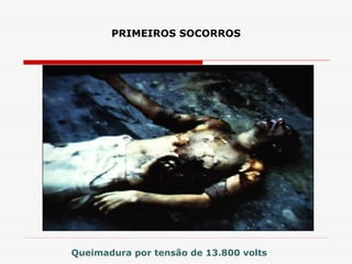 PRIMEIROS SOCORROS
Queimadura por tensão de 13.800 volts
 
