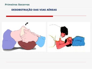 DESOBSTRUÇÃO DAS VIAS AÉREAS
Primeiros Socorros
 