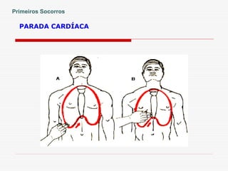 PARADA CARDÍACA
Primeiros Socorros
 
