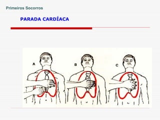PARADA CARDÍACA
Primeiros Socorros
 