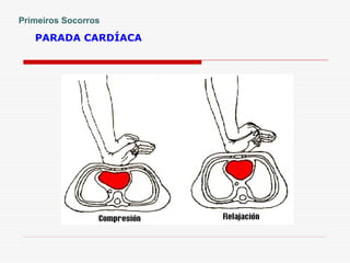 PARADA CARDÍACA
Primeiros Socorros
 