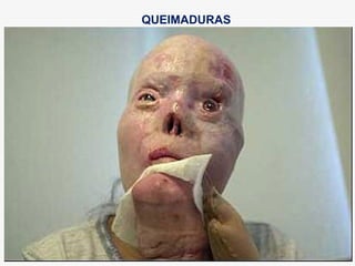 QUEIMADURAS
 