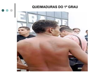 QUEIMADURAS DO 1º GRAU
 