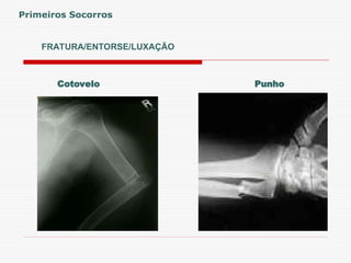 FRATURA/ENTORSE/LUXAÇÃO
Primeiros Socorros
Punho
Cotovelo
 