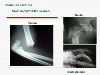FRATURA/ENTORSE/LUXAÇÃO
Primeiros Socorros
Bacia
Dedo da mão
Fêmur
 
