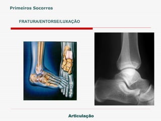 FRATURA/ENTORSE/LUXAÇÃO
Primeiros Socorros
Articulação
 