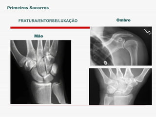 FRATURA/ENTORSE/LUXAÇÃO
Primeiros Socorros
Ombro
Mão
 