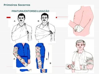 FRATURA/ENTORSE/LUXAÇÃO
Primeiros Socorros
 