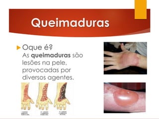 Queimaduras
 Oque é?
As queimaduras são
lesões na pele,
provocadas por
diversos agentes.
 