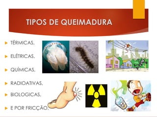 TIPOS DE QUEIMADURA
 TÉRMICAS,
 ELÉTRICAS,
 QUÍMICAS,
 RADIOATIVAS,
 BIOLOGICAS,
 E POR FRICÇÃO.
 
