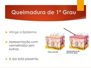 Queimadura de 1º Grau
 Atinge a Epiderme
 Apresentação com
vermelhidão sem
bolhas
 A dor está presente.
 