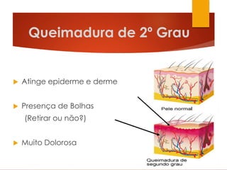 Queimadura de 2º Grau
 Atinge epiderme e derme
 Presença de Bolhas
(Retirar ou não?)
 Muito Dolorosa
 