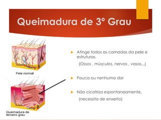 Queimadura de 3º Grau
 Atinge todos as camadas da pele e
estruturas.
(Ossos , músculos, nervos , vasos...)
 Pouca ou nenhuma dor
 Não cicatriza espontaneamente,
(necessita de enxerto)
 