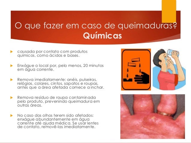 Primeiros socorros - Queimaduras