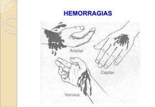 HEMORRAGIAS
 