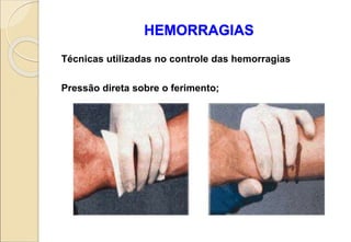 HEMORRAGIAS
Técnicas utilizadas no controle das hemorragias
Pressão direta sobre o ferimento;
 