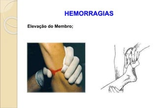 HEMORRAGIAS
Elevação do Membro;
 