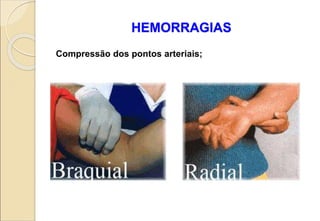 HEMORRAGIAS
Compressão dos pontos arteriais;
 