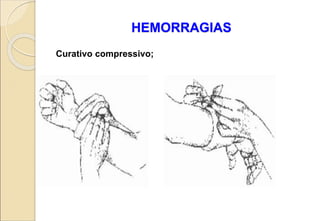 HEMORRAGIAS
Curativo compressivo;
 