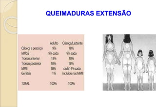 QUEIMADURAS EXTENSÃO
 
