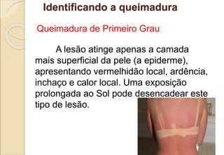 Identificando a queimadura
Queimadura de Primeiro Grau
A lesão atinge apenas a camada
mais superficial da pele (a epiderme),
apresentando vermelhidão local, ardência,
inchaço e calor local. Uma exposição
prolongada ao Sol pode desencadear este
tipo de lesão.
 