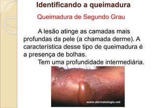 Queimadura de Segundo Grau
A lesão atinge as camadas mais
profundas da pele (a chamada derme). A
característica desse tipo de queimadura é
a presença de bolhas.
Tem uma profundidade intermediária.
Identificando a queimadura
 