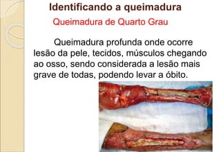 Queimadura de Quarto Grau
Queimadura profunda onde ocorre
lesão da pele, tecidos, músculos chegando
ao osso, sendo considerada a lesão mais
grave de todas, podendo levar a óbito.
Identificando a queimadura
 