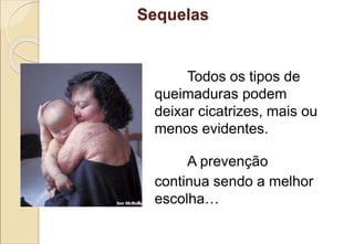 Sequelas
Todos os tipos de
queimaduras podem
deixar cicatrizes, mais ou
menos evidentes.
A prevenção
continua sendo a melhor
escolha…
 