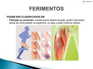 PODEM SER CLASSIFICADOS EM
 Fechado ou contusão: a lesão ocorre abaixo da pele, porém não existe
perda da continuidade na superfície, ou seja, a pele continua intacta;
 